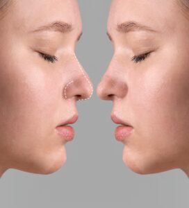 conceito-de-cirurgia-de-rinoplastia-com-modelo-de-mulher_23-2150036909-272x300 conceito-de-cirurgia-de-rinoplastia-com-modelo-de-mulher_23-2150036909
